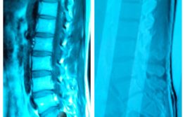 Spine Surgery Alternatives