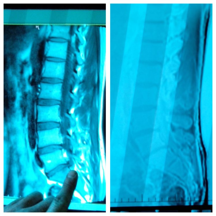 Spine Surgery Alternatives